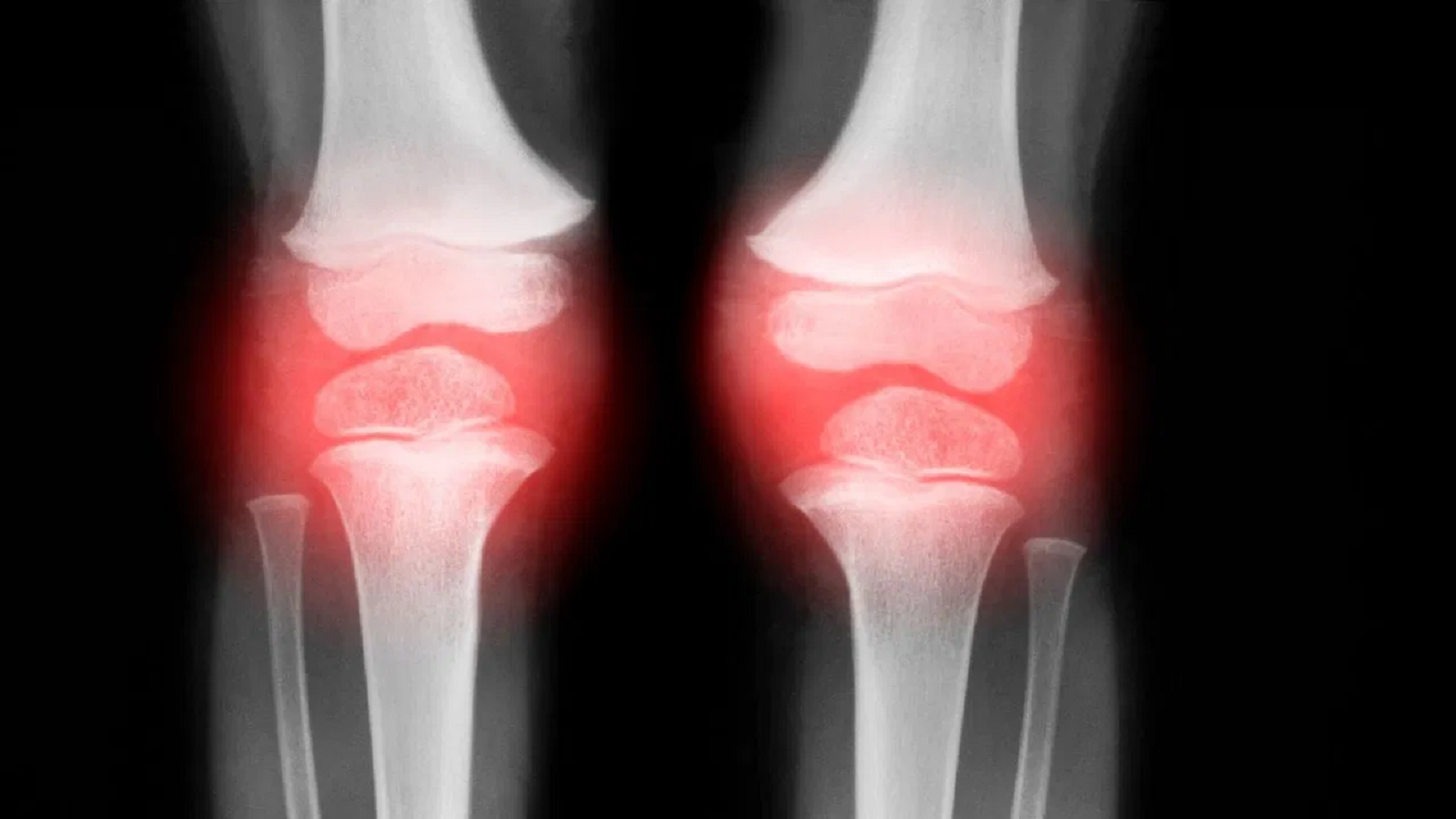 Causes and Prevention of Weak Bones: Expert Advice from Dr. Akhilesh Yadav