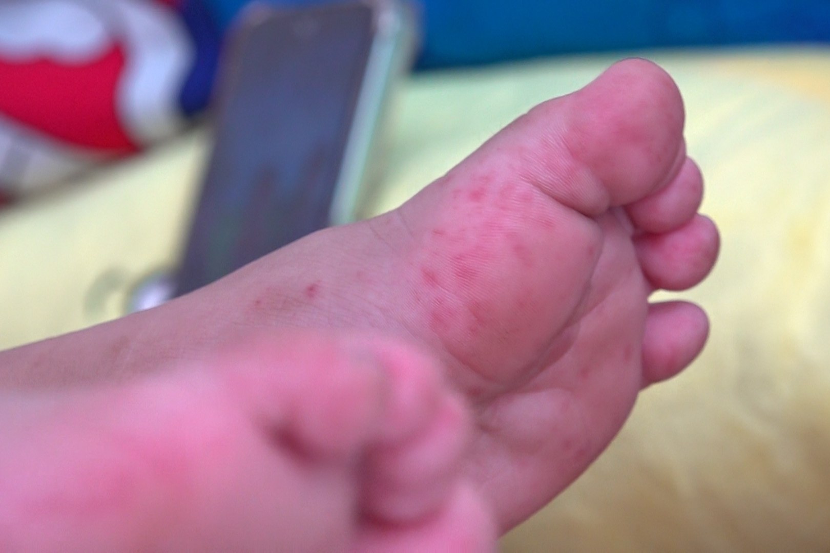 Miền Tây ghi nhận hơn 10.000 ca tay chân miệng