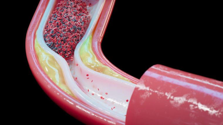 The radical theory about heart attacks – and the common gout drug that ...