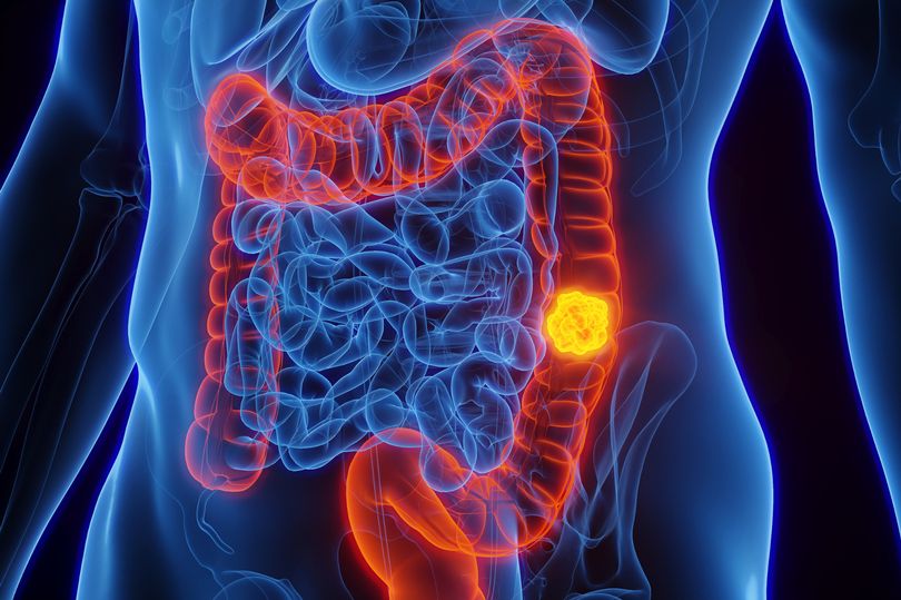 Doctor warns of six colon cancer symptoms you should 'never ignore'