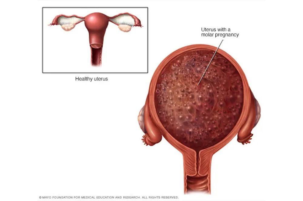 Cara Menghindari Kehamilan Anggur dan Penyebabnya