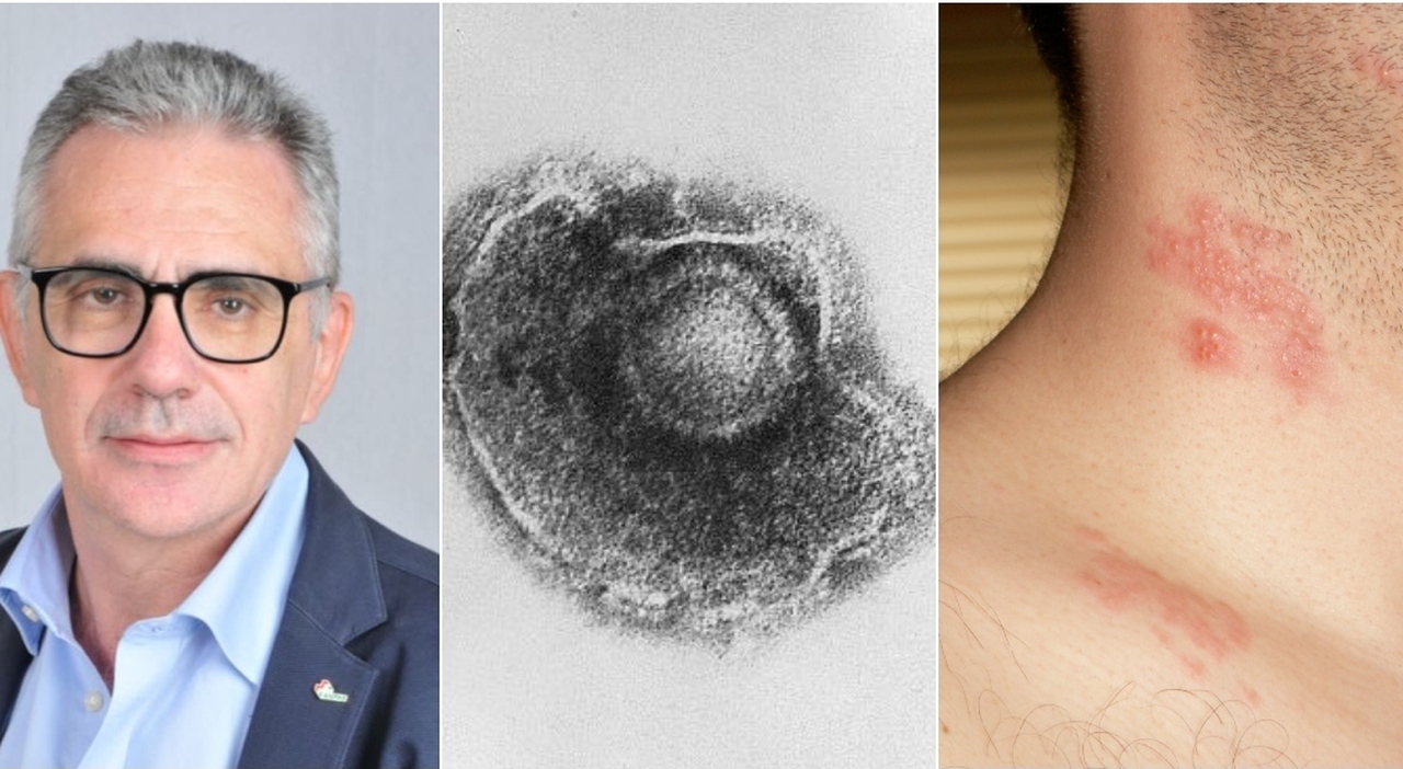 Fuoco di Sant'Antonio, aumentano i casi. Pregliasco: «Attenzione agli ...