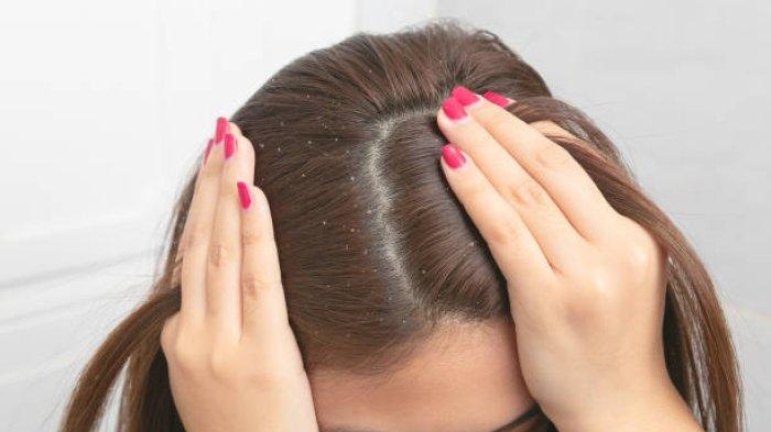 Kandungan Sampo Ampuh untuk Atasi Ketombe, Ini Penjelasan Dokter