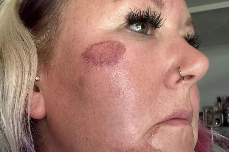 Mum 'faceplanted' pavement after being 'spiked' on 40th birthday night out