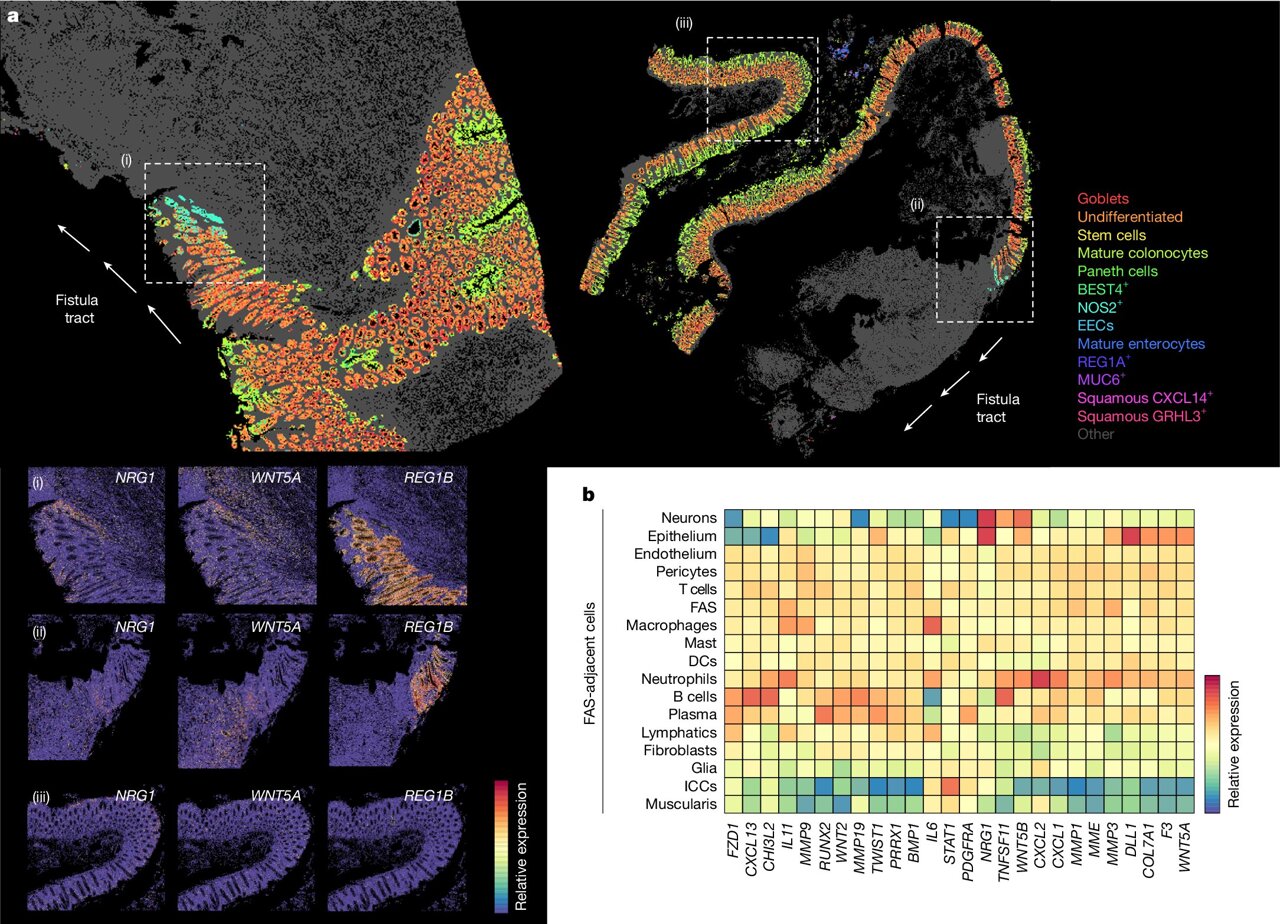 Scientists map the cells that drive Crohn's disease fistulas