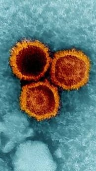 Scientists Say Epstein-Barr Virus May Trigger Lupus Disease...