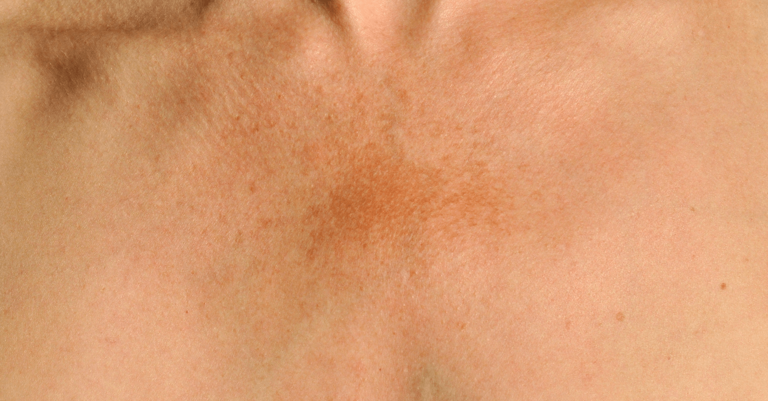If you suddenly see a brown patch on your skin, here’s what it could ...