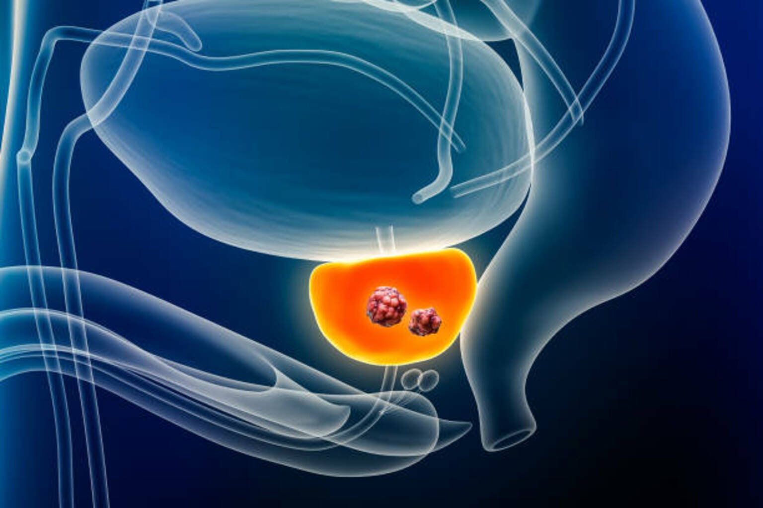 Myriad, SOPHiA partner with AstraZeneca to use prostate cancer technology