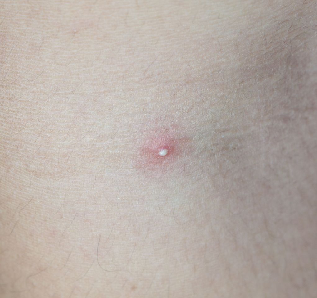 How to Clear a Cystic Pimple: Your Ultimate Guide to Relief