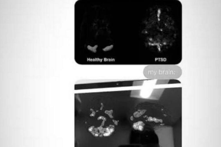 Ariana Grande's brain scan reveals result of 'years of PTSD' after ...