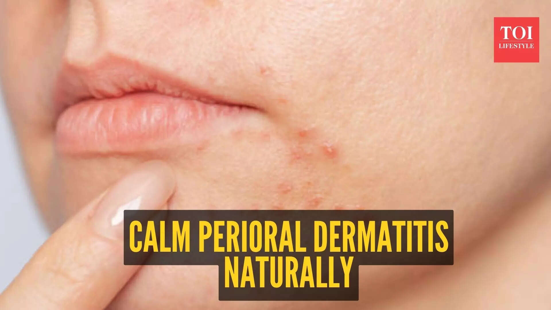 5-natural-home-remedies-to-deal-with-perioral-dermatitis