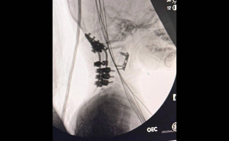 La operación realizada en Chicago volvió a unir la cabeza de Oliver con su médula espinal y columna. Foto: Cortesía Familia Staub-García