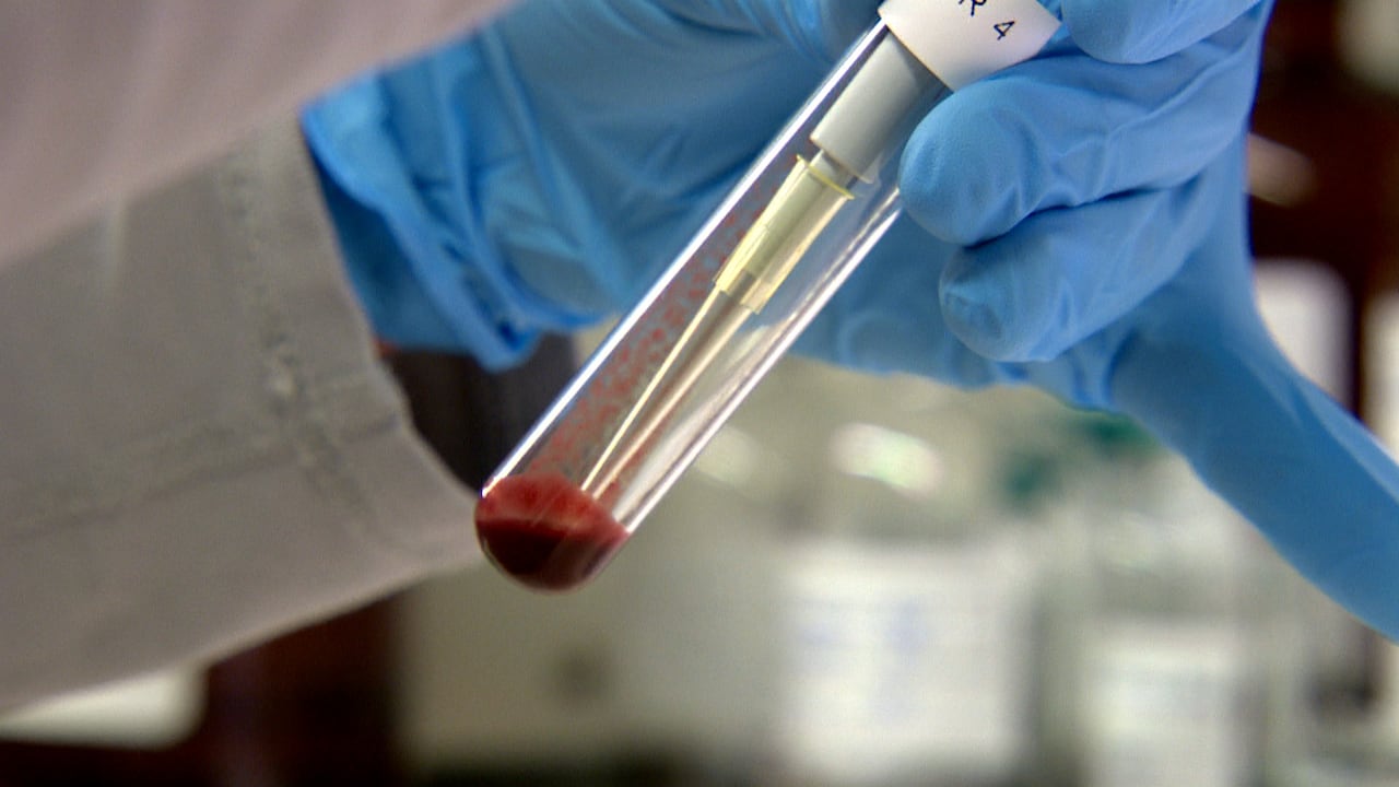 Stage 4 prostate cancer cases increased after reduction in PSA ...
