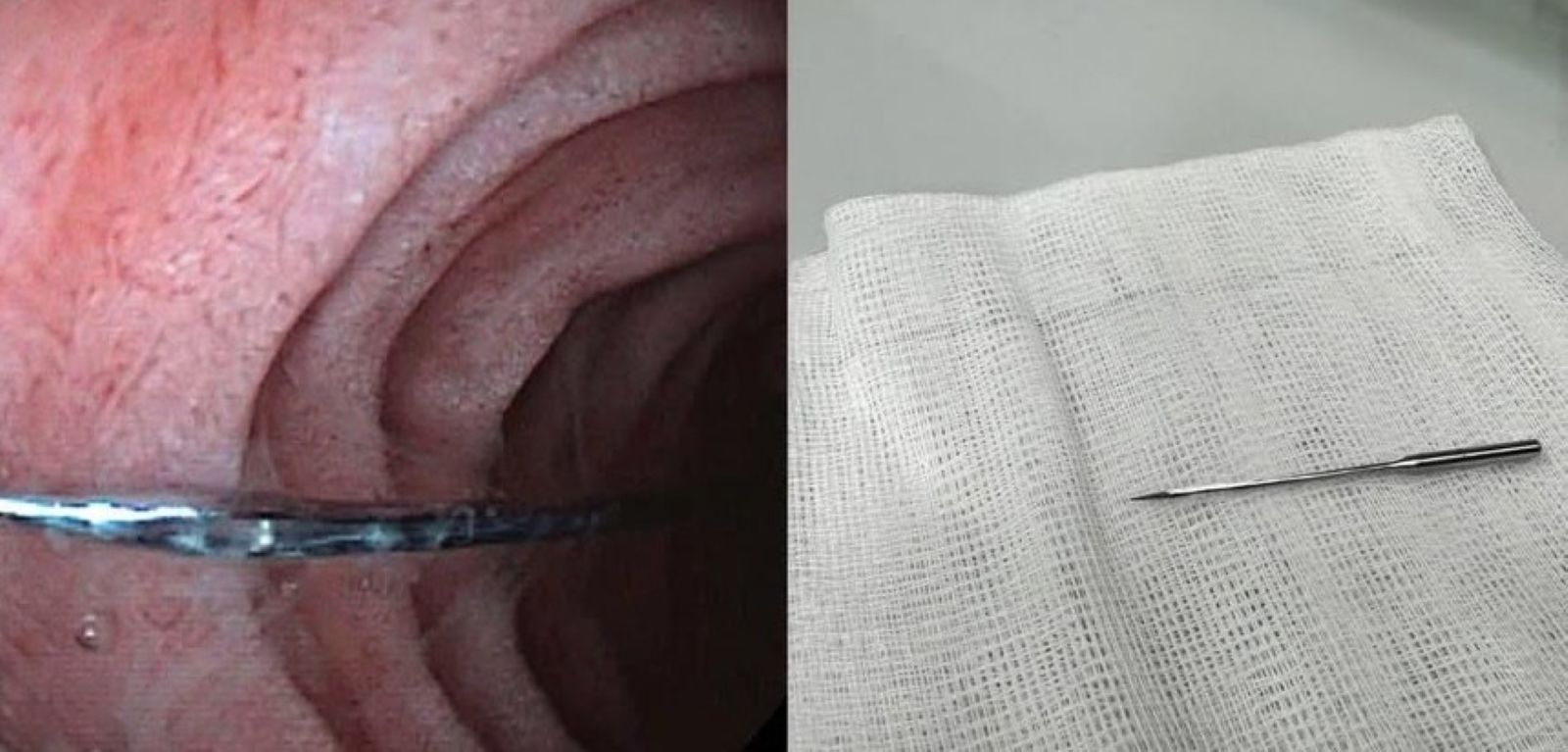 Cảnh giác nuốt dị vật ở trẻ, nguy cơ biến chứng cao nếu chậm xử lý