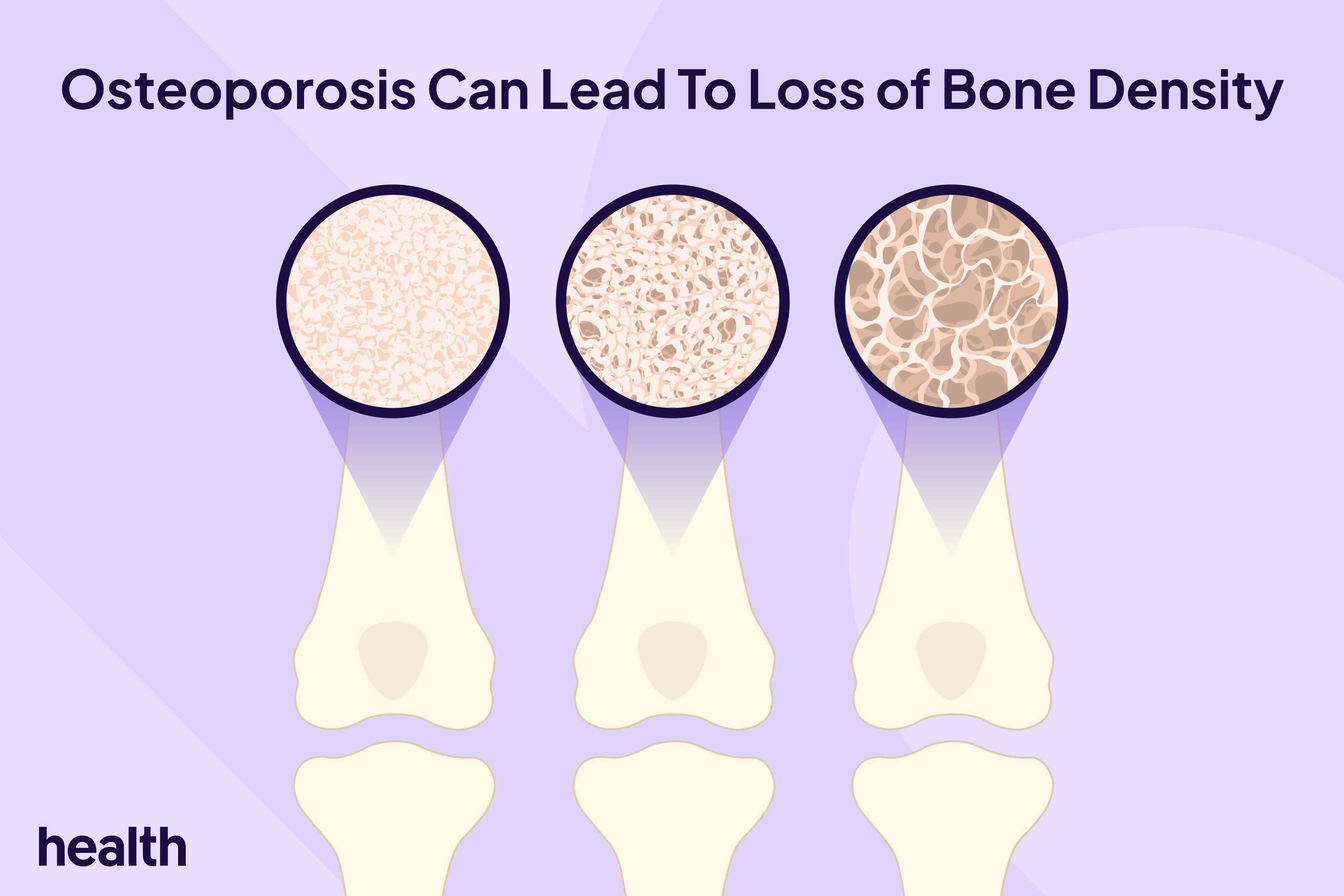 How to build bone density: 7 tips for stronger bones