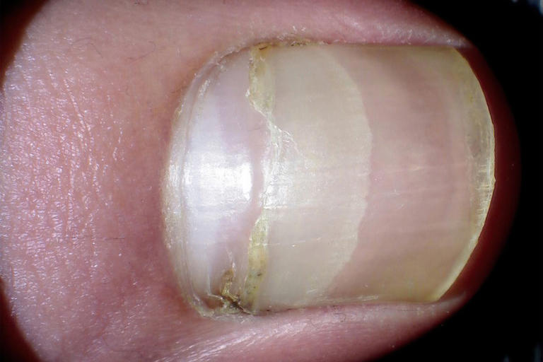 What causes vertical and horizontal ridges in nails?