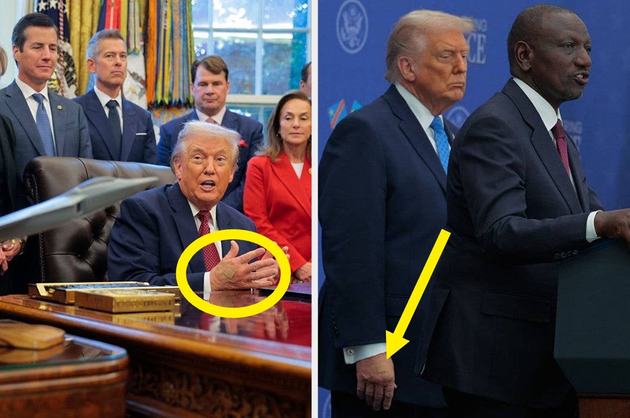 Everyone is talking about what's happening with Trump's hand this week