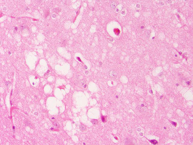 Prion-like brain damage can occur without infectious prions, study finds