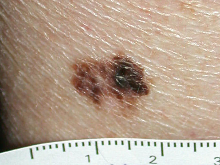 What does skin cancer look like?