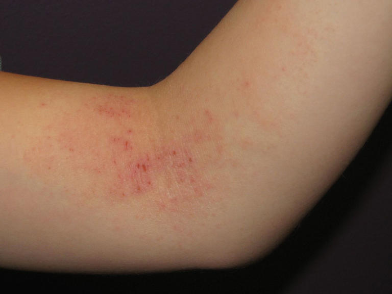 16 skin rash types: Pictures, causes, and treatment