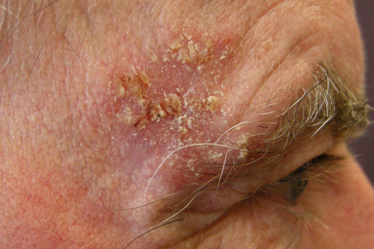 What does skin cancer look like?
