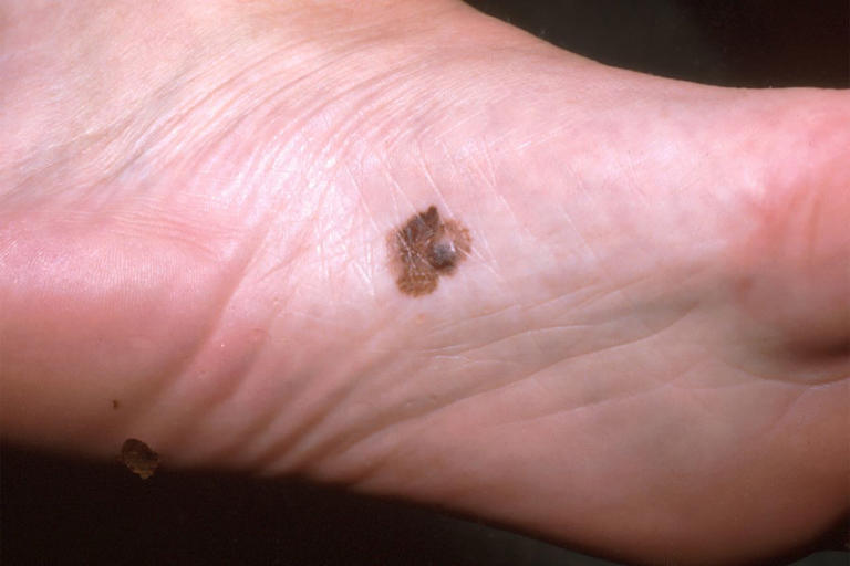 What does skin cancer look like?