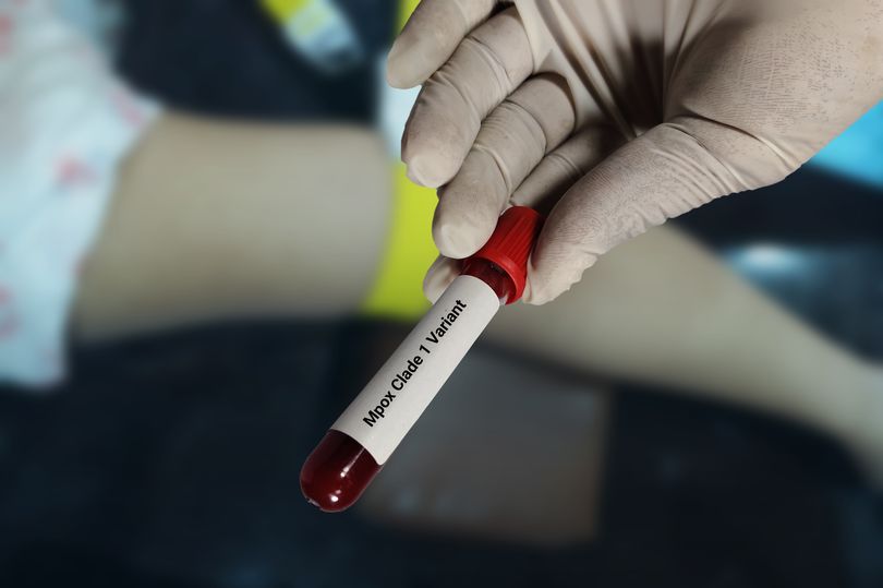 Symptoms of MPOX amid 'concern' over new virus strain detected in England