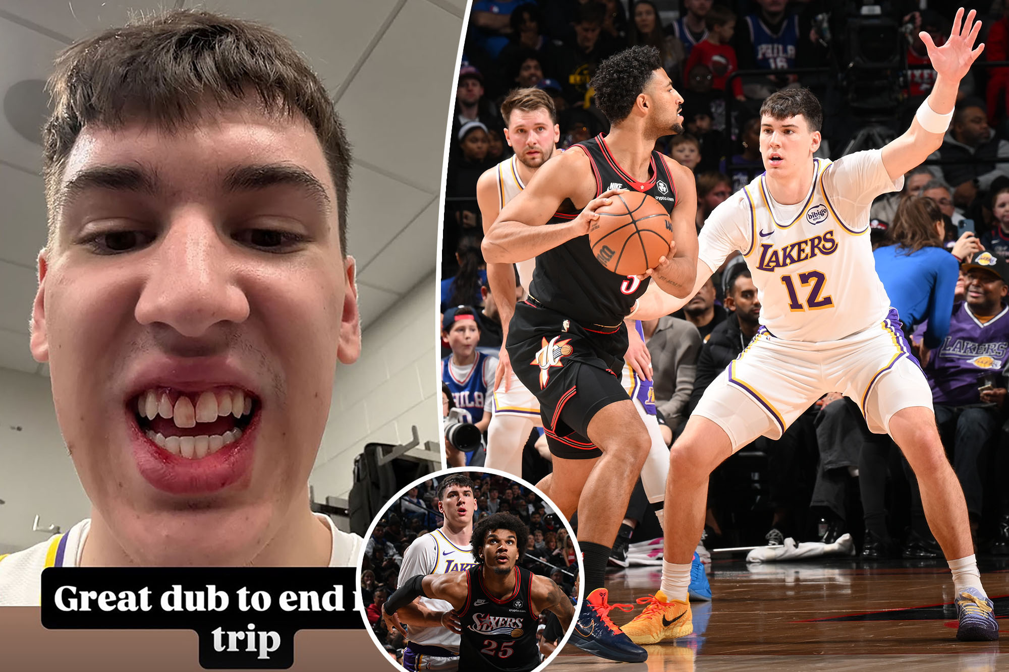 Lakers’ Jake LaRavia shows off gnarly tooth injury after Sixers game