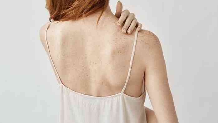 4 cara efektif menghilangkan jerawat tubuh