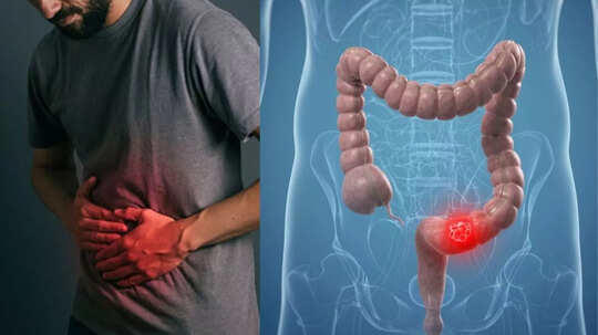 UK Man Shares 'Common' Symptoms He Ignored Before His Colon Cancer ...