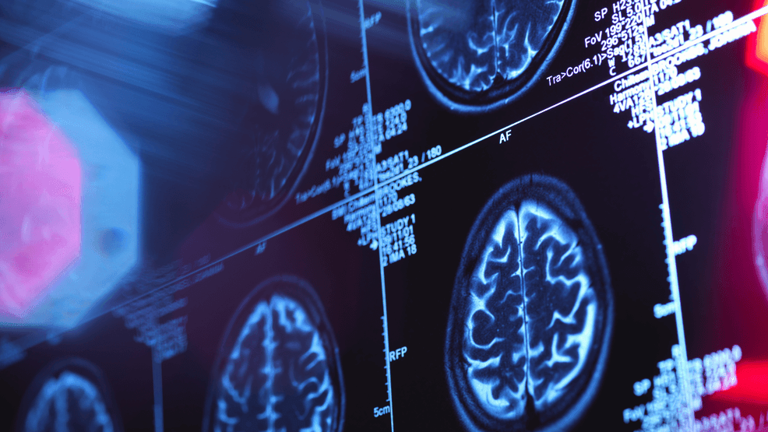 Young memory loss patients don't have to walk the path of Alzheimer's alone