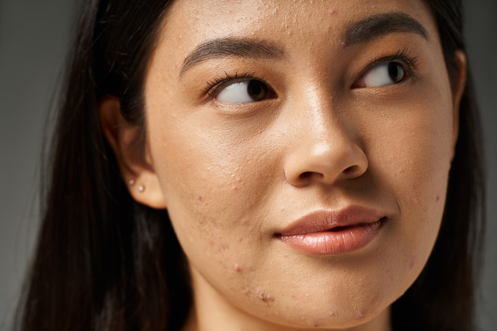 How to prevent pimples: 15 tips to eliminate acne - Medical News Today