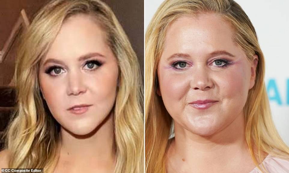 amy schumer plastic surgery Image 1