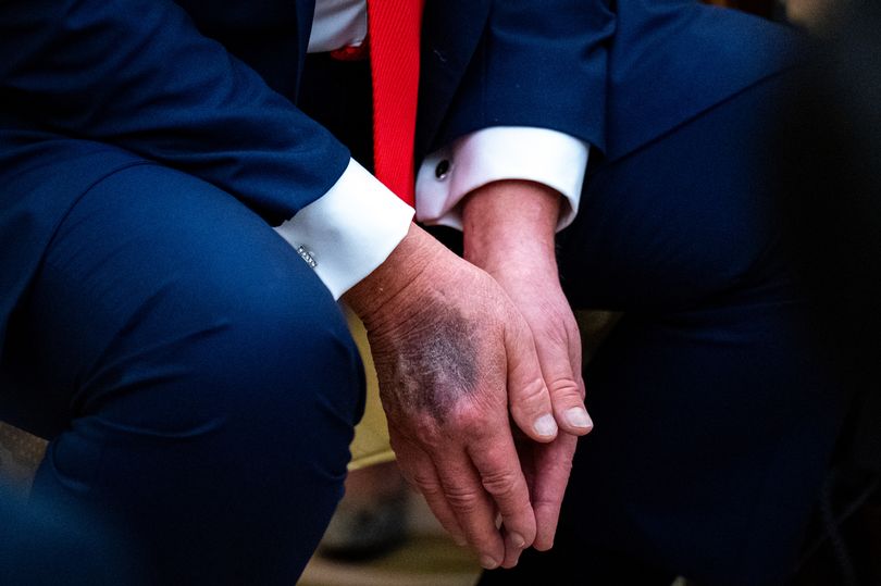 Trump has been pictured with bruising on his hands