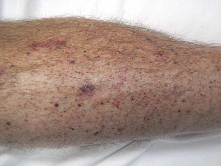 What is a mono rash?