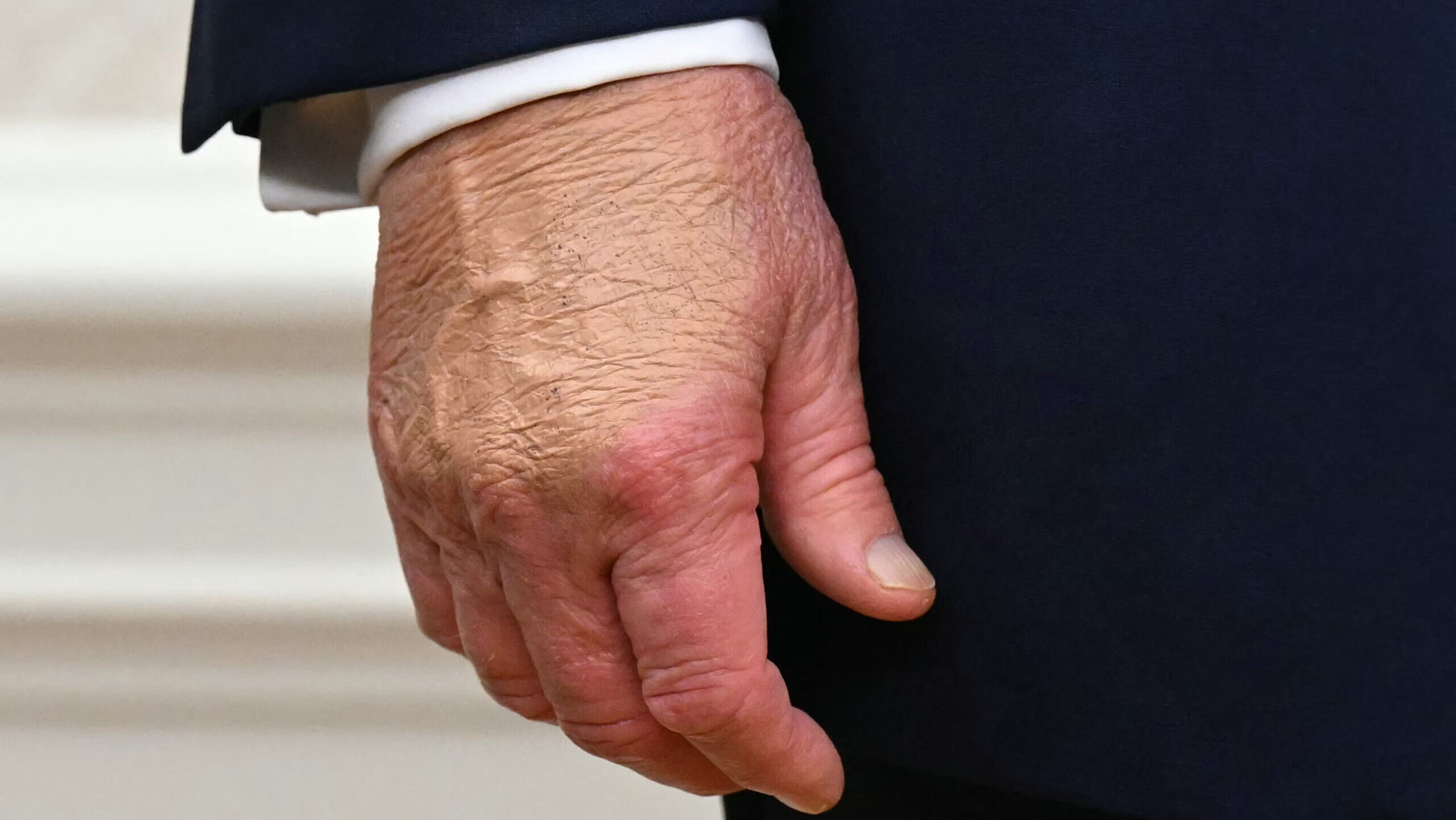 Viral video explains Donald Trump’s hand bruising and signs of dementia