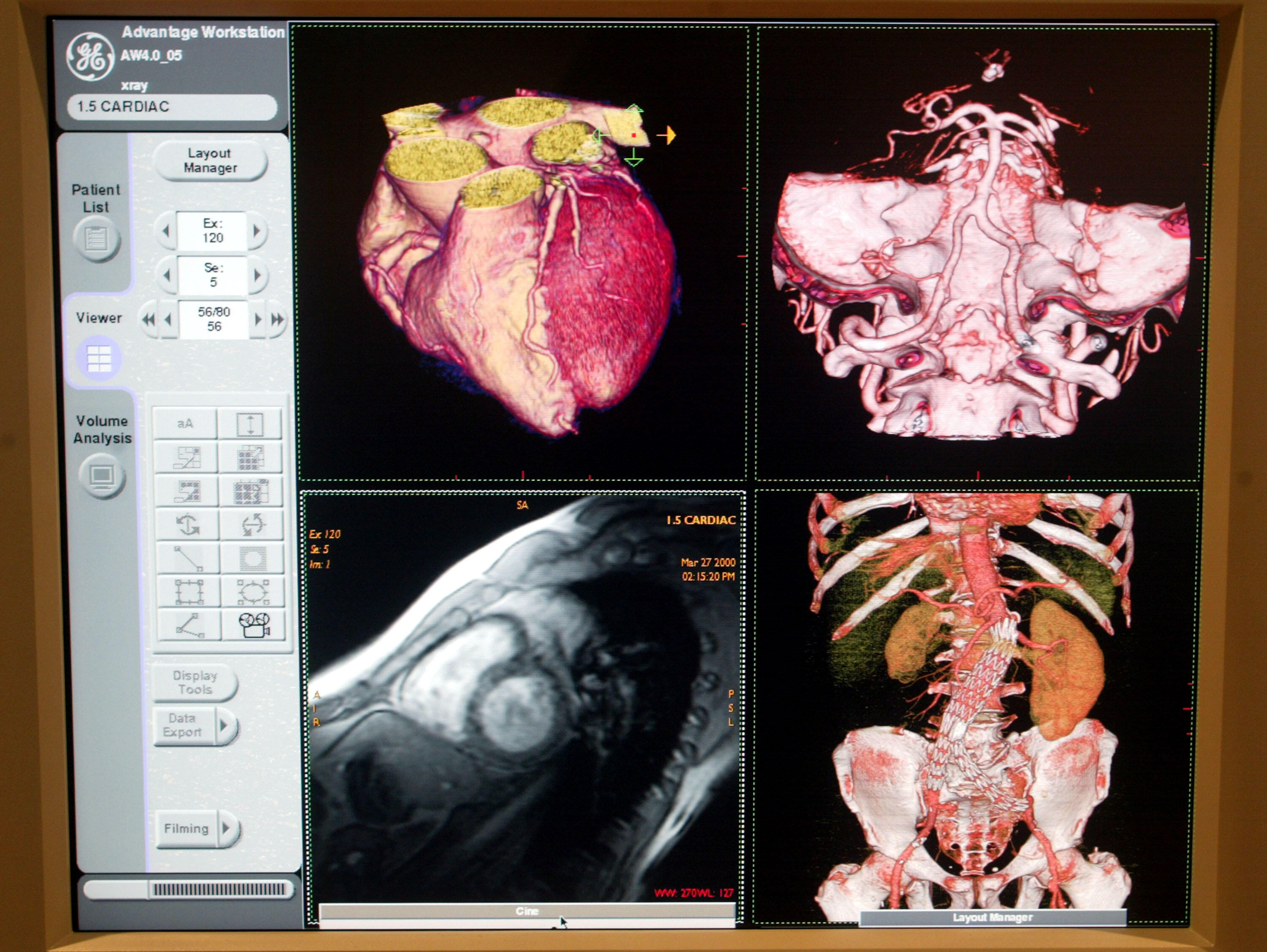 The Broward Heart Project is back offering free heart scans