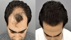 Tren tanam rambut pria, ubah rasa minder jadi investasi penampilan