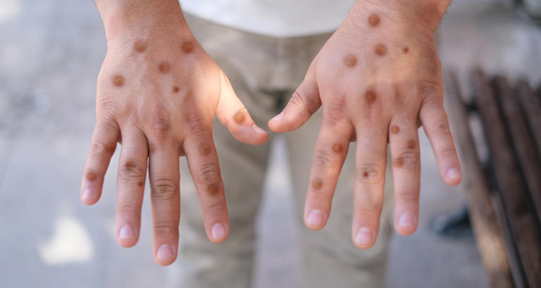 New MPOX variant detected – these are the symptoms to watch for