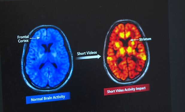 Brain rot: How short-form videos affect brain health