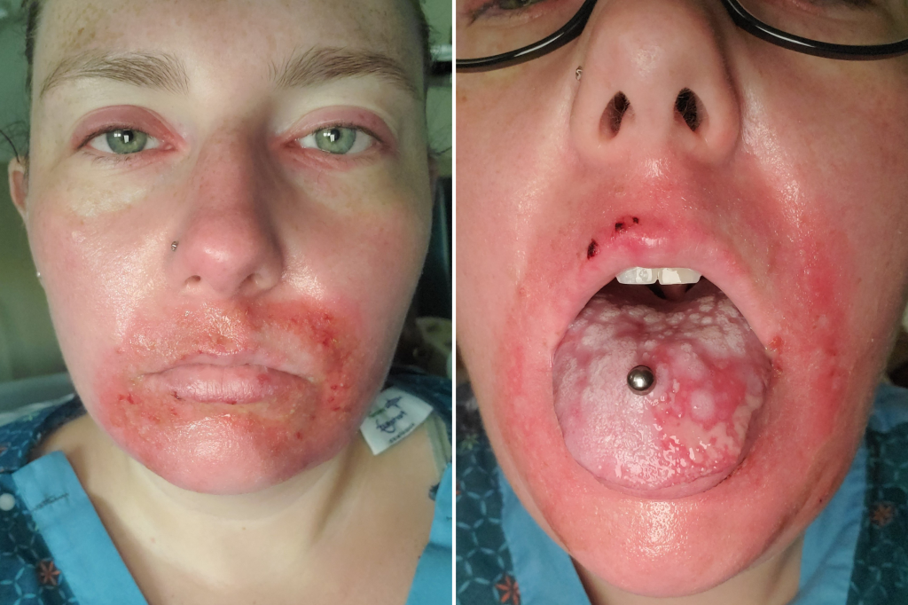 From left: Richardson on July 31, 2023 and ulcers in her mouth in August 2023.