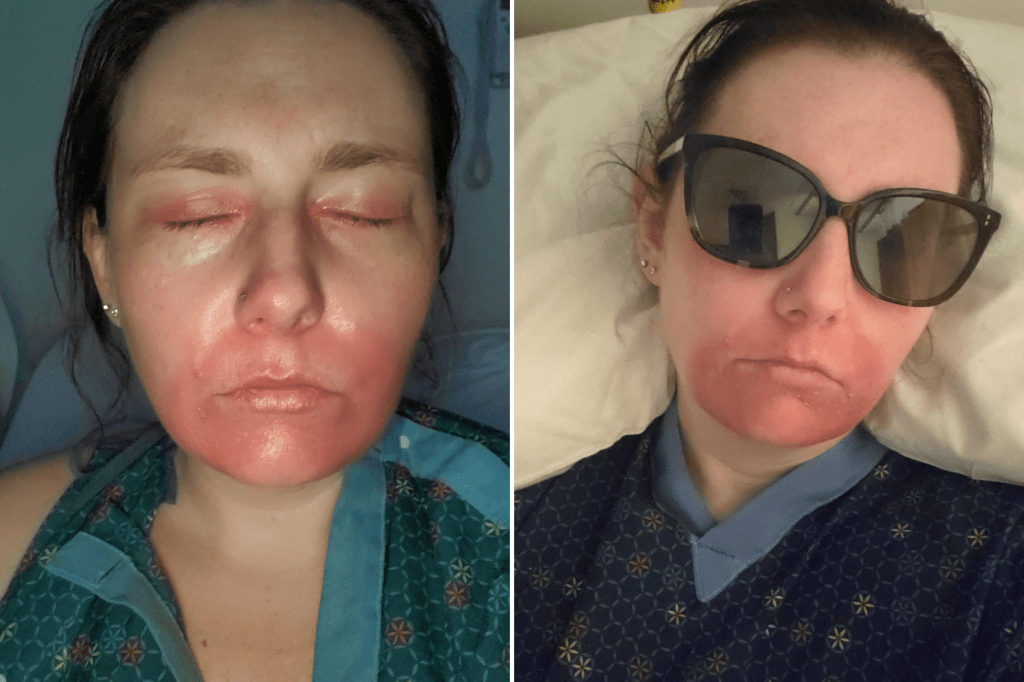 From left: Richardson in February 2024, and May 2024 unable to open her eyes.