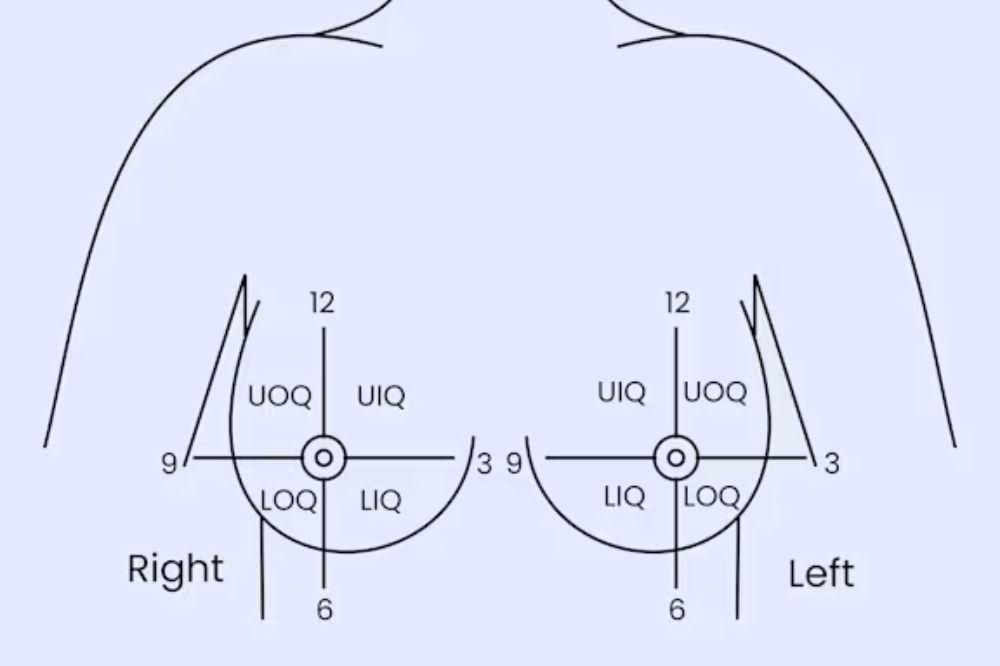 Letak Kanker Payudara yang Paling Umum