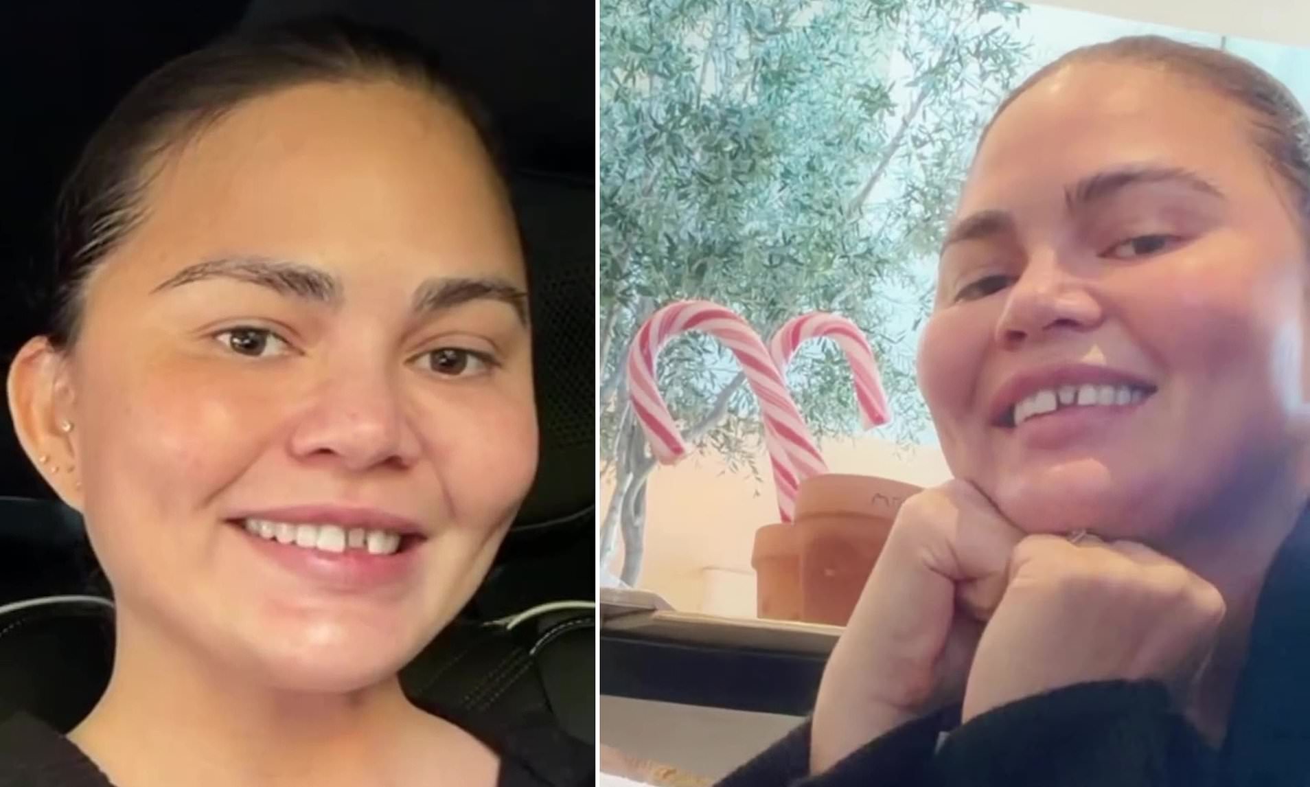 Chrissy Teigen reveals chipped tooth after candy cane game mishap with