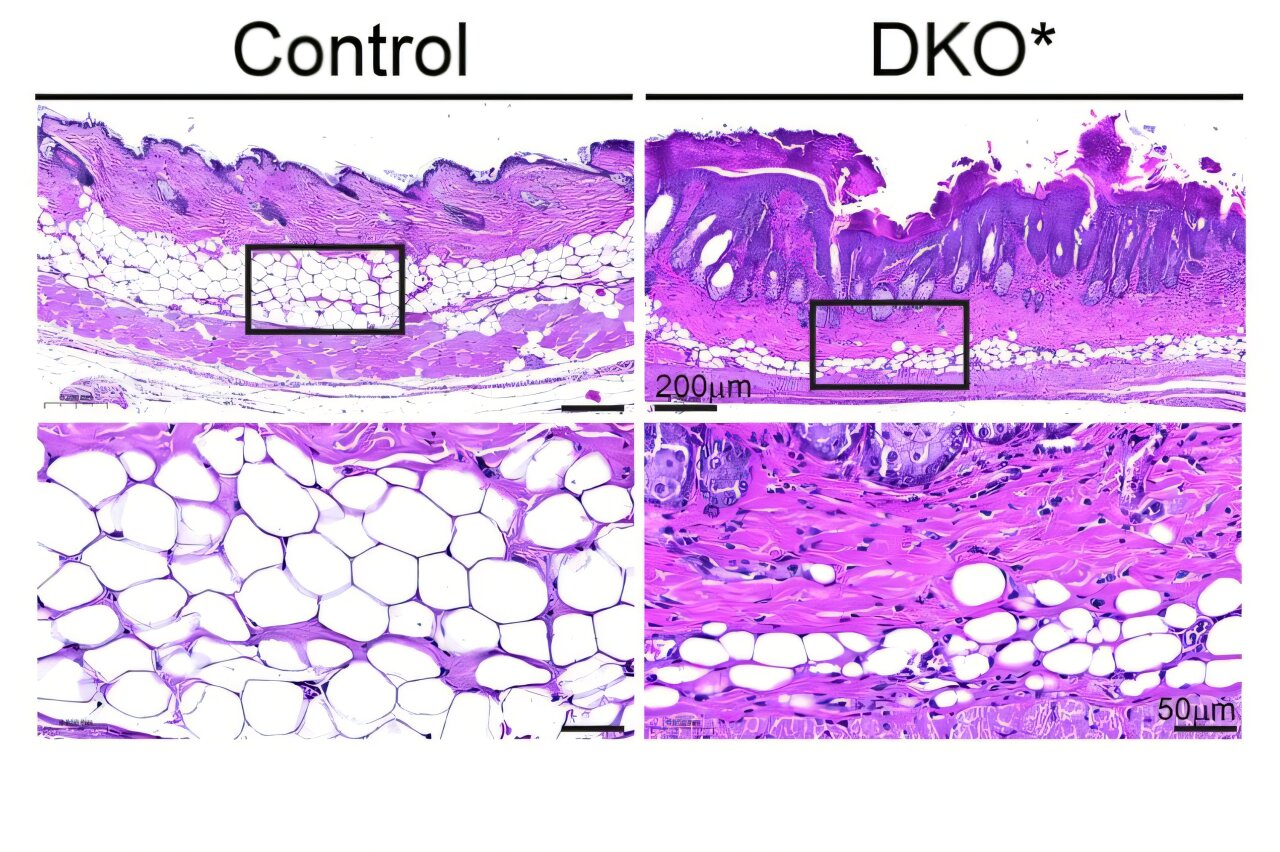 Psoriasis study shows link between fat metabolism and skin inflammation for first time<br><br>