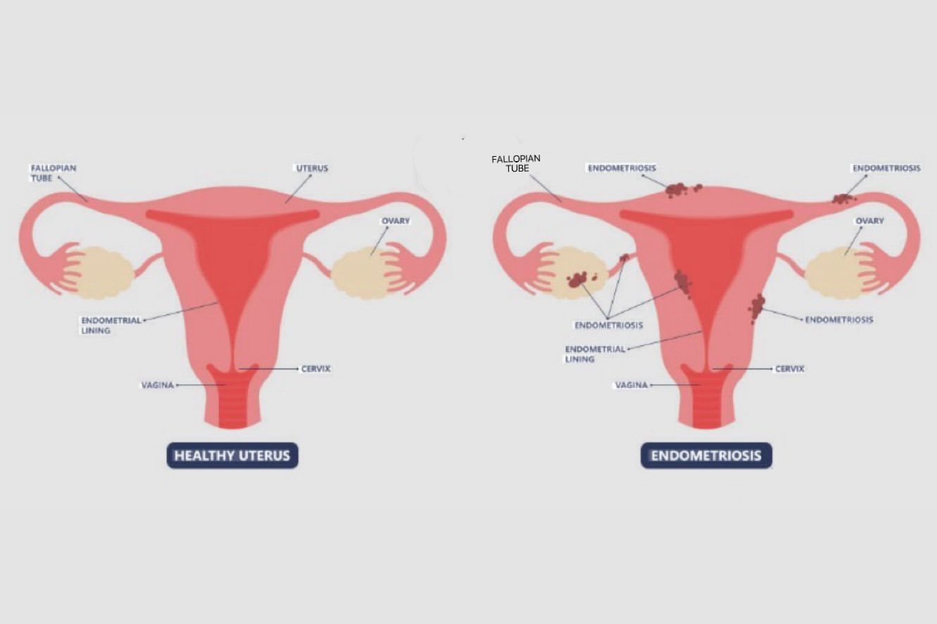 Tanda-tanda wanita penderita endometriosis, salah satunya nyeri haid