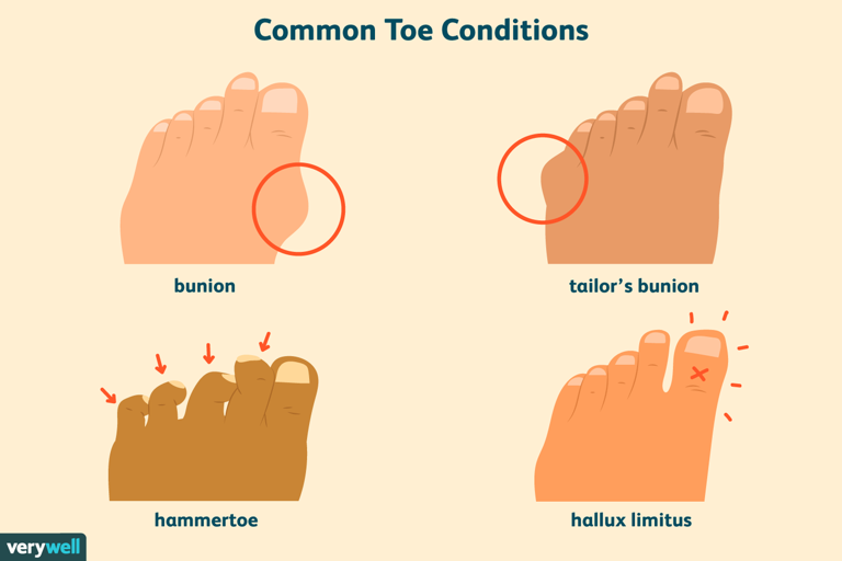 4 common toe problems that make feet look abnormal