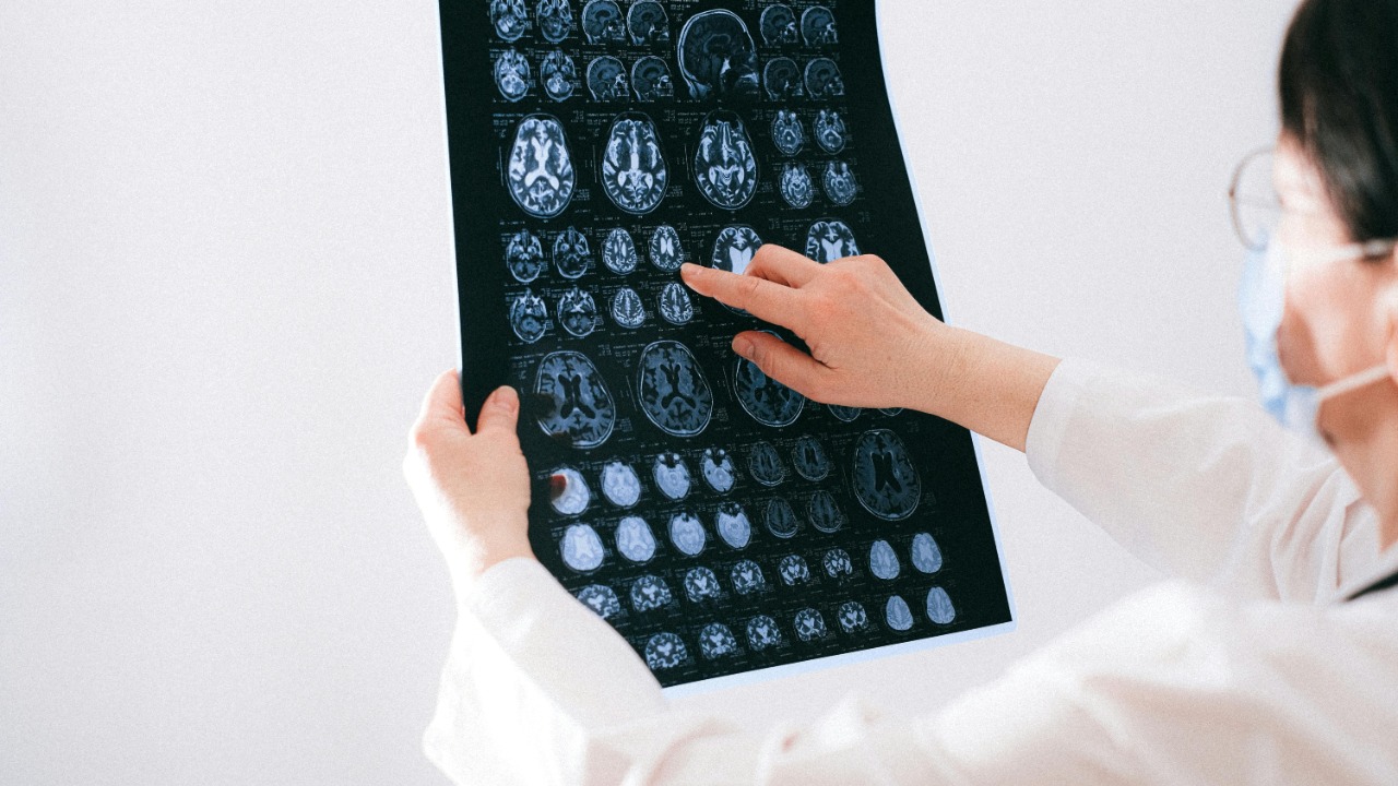 Routine brain scans may hide an early Alzheimer’s warning