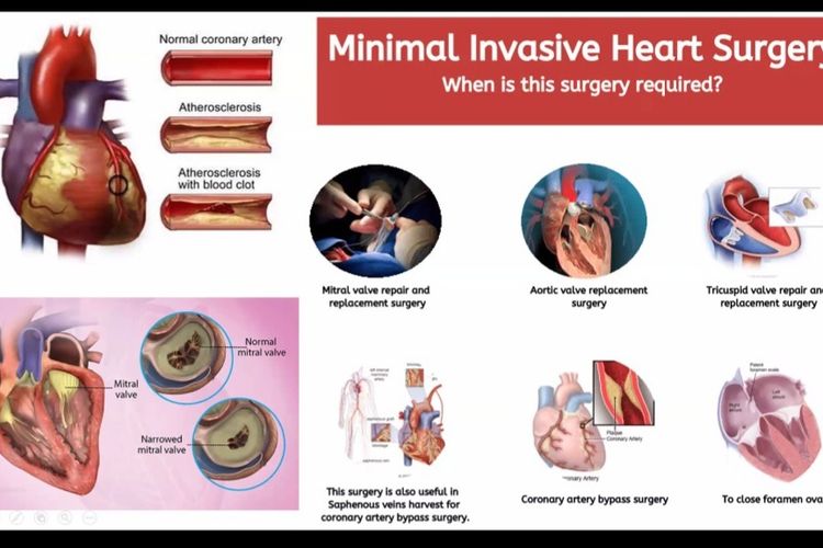 Atasi Kebocoran Jantung dengan 3 Tindakan Kompleks, Pertama di Indonesia dan Ketiga di Dunia