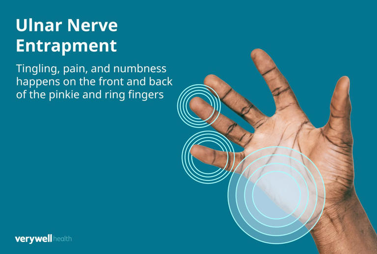 Ulnar nerve entrapment causes and treatment